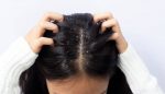 Dandruff
