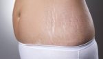 Stretch marks