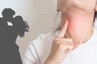 Kissing Disease