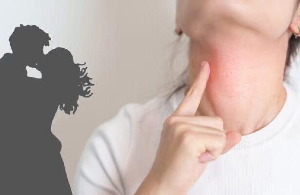 Kissing Disease