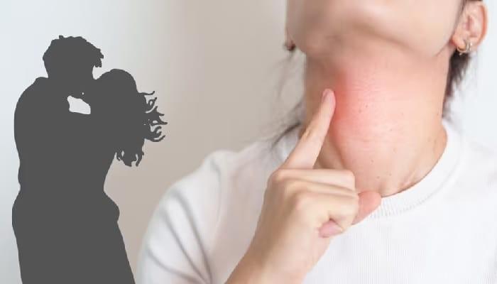 Kissing Disease